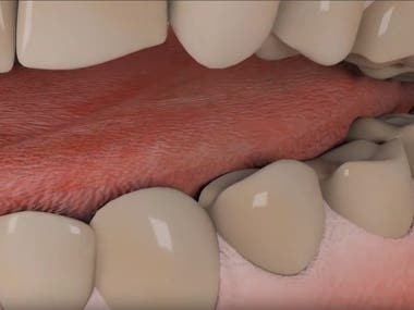 3d dental process animation