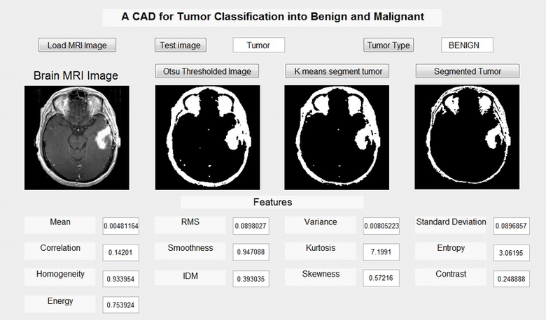 a cad for tumor classification into benign and malignant